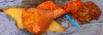 LITTRE'S HERNIA