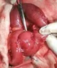 MAYDL'S HERNIA