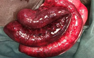 MAYDL'S HERNIA