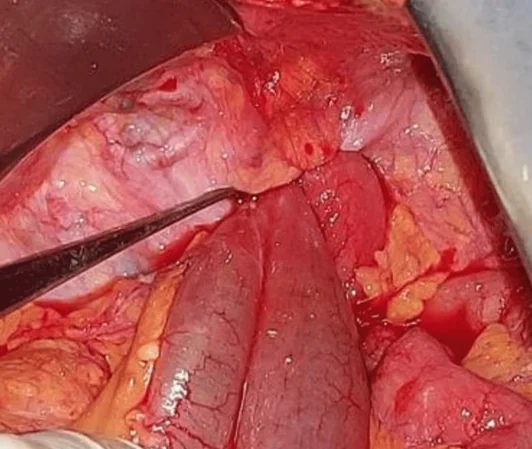 OBTURATOR FORAMEN HERNIA