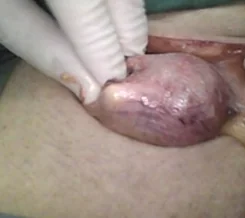 OGILVIE'S HERNIA - URINARY BLADDER