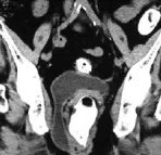 PERINEAL HERNIA - URINARY BLADDER 