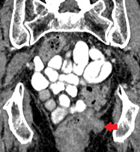 PERINEAL HERNIA