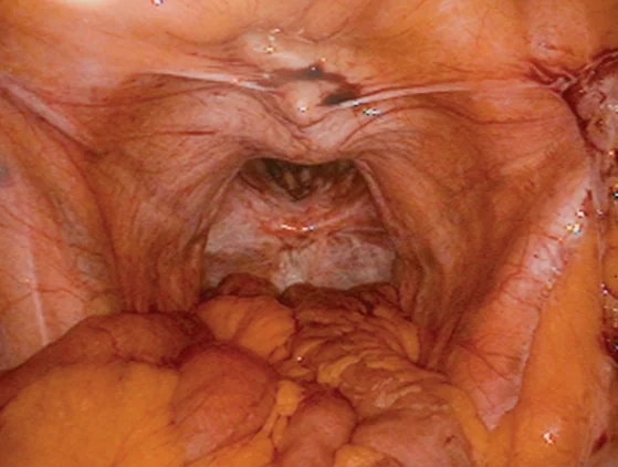 PERINEAL HERNIA