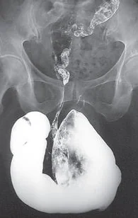 PERINEAL HERNIA