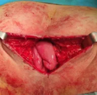 PERINEAL HERNIA