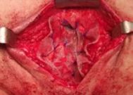 PERINEAL HERNIA REPAIR - MESH