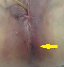 PERINEAL HERNIA