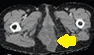 PERINEAL HERNIA
