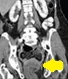 PERINEAL HERNIA