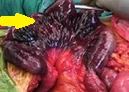 PERINEAL HERNIA - INTESTINAL NECROSIS