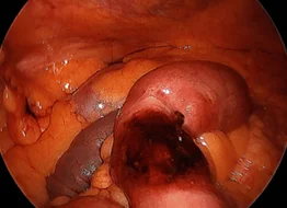 REDUCED RICHTER'S HERNIA
