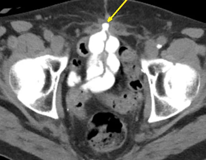 RICHTER'S HERNIA