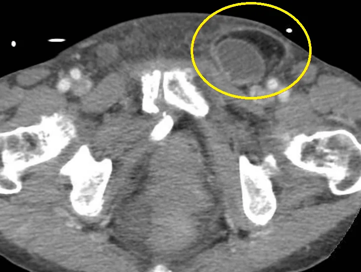 RICHTER'S HERNIA