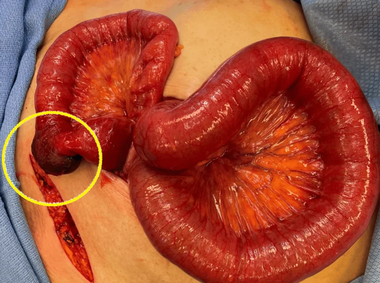 RICHTER'S HERNIA