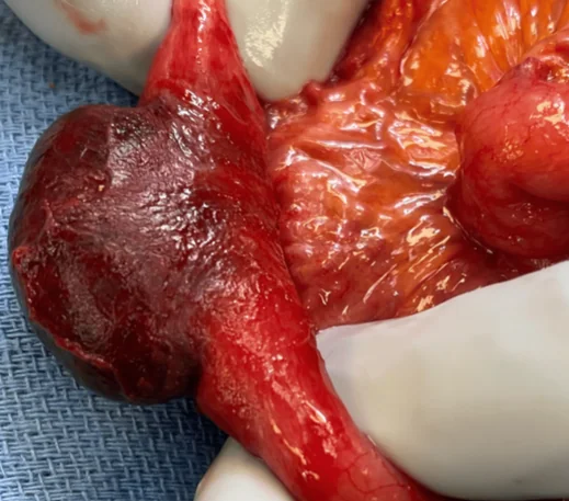 RICHTER'S HERNIA