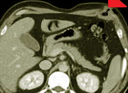 RICHTER'S HERNIA
