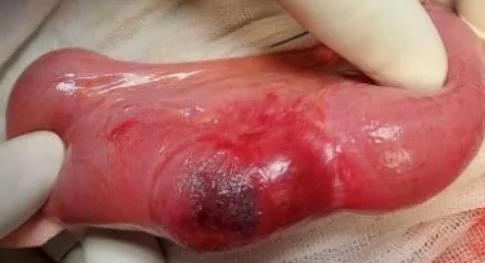 RICHTER'S HERNIA