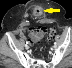 RICHTER'S HERNIA