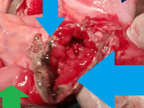 RICHTER'S HERNIA - ILEUM PERFORATION