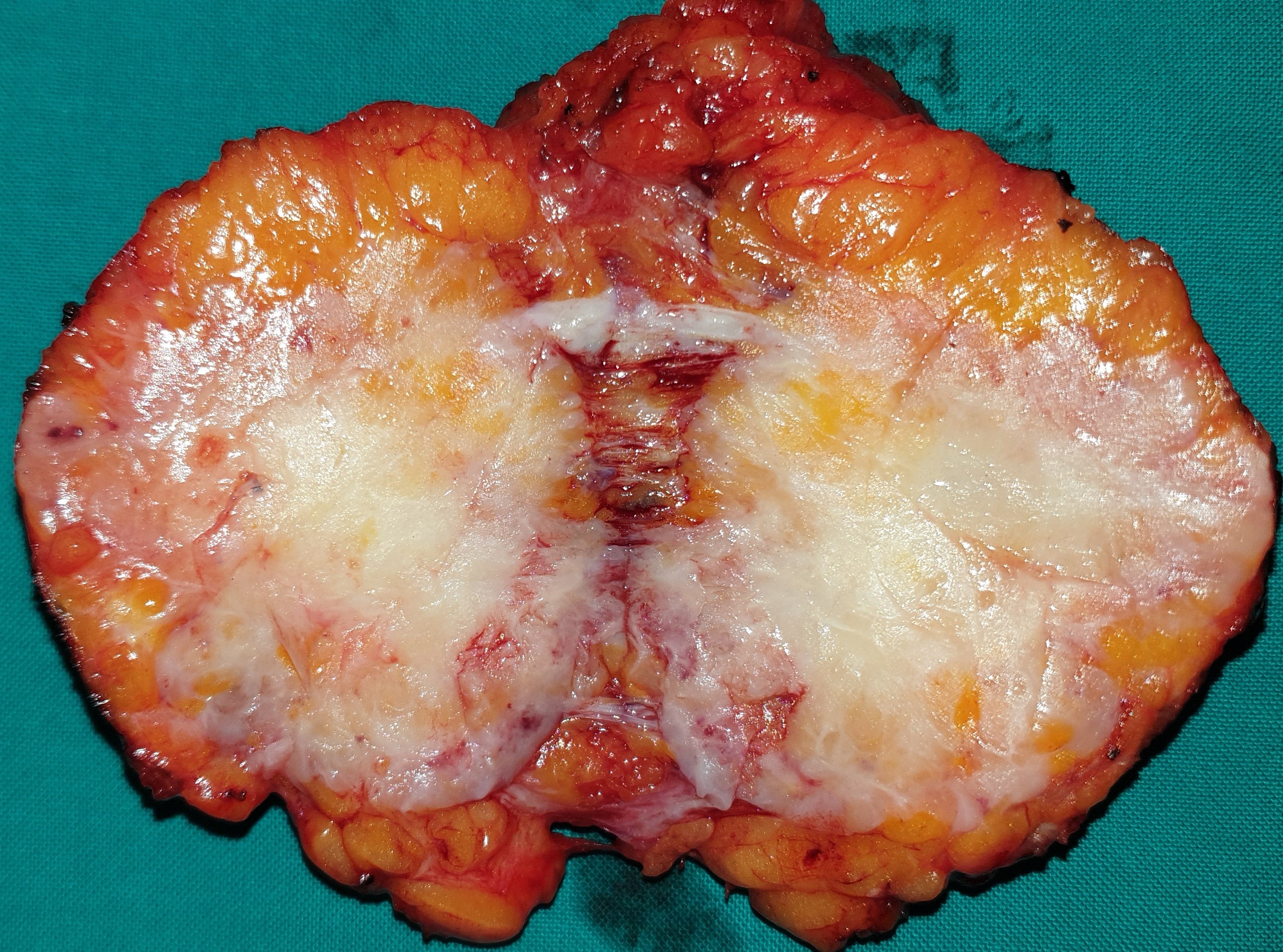 BREAST CARCINOMA