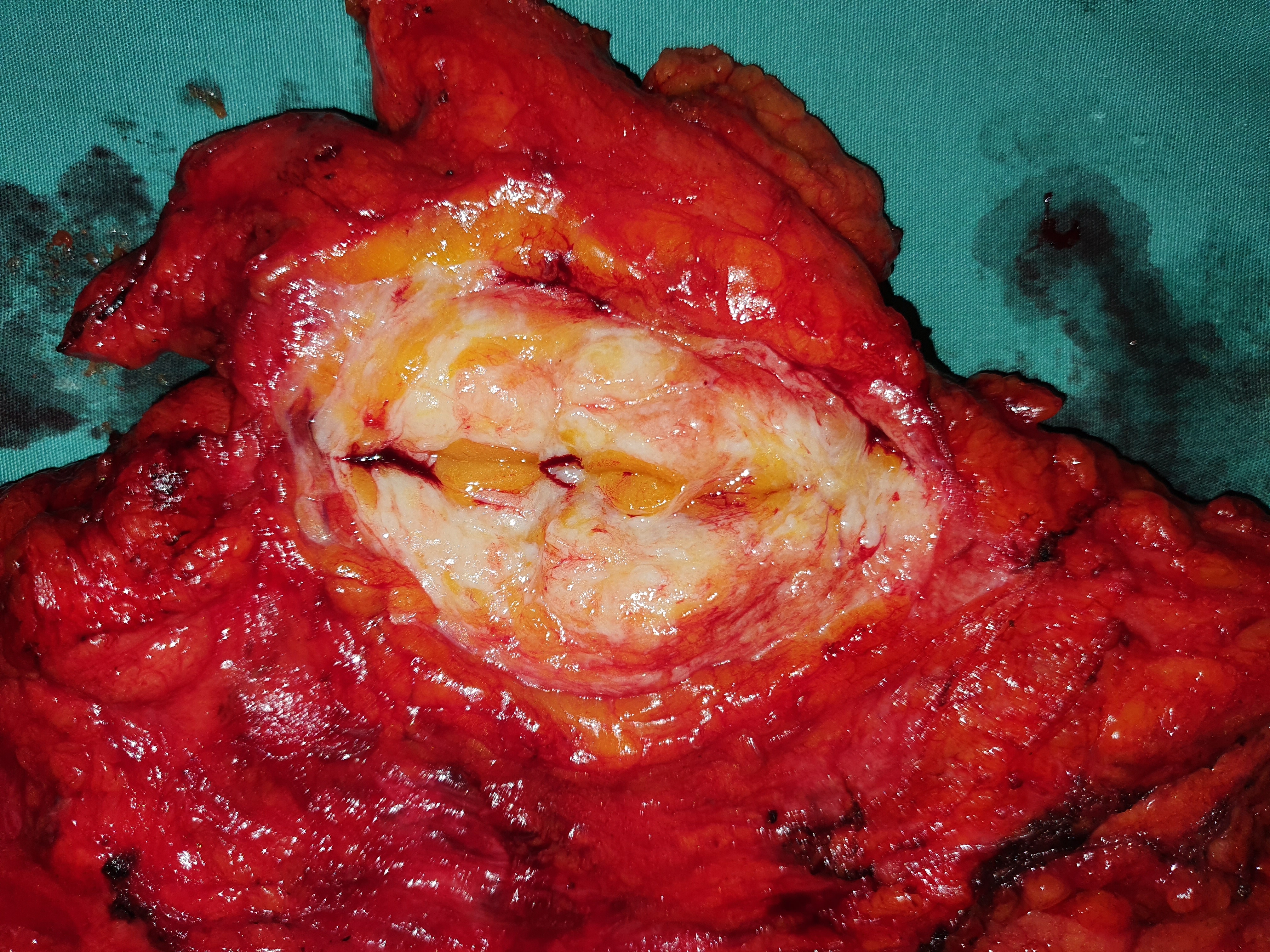 BREAST CARCINOMA