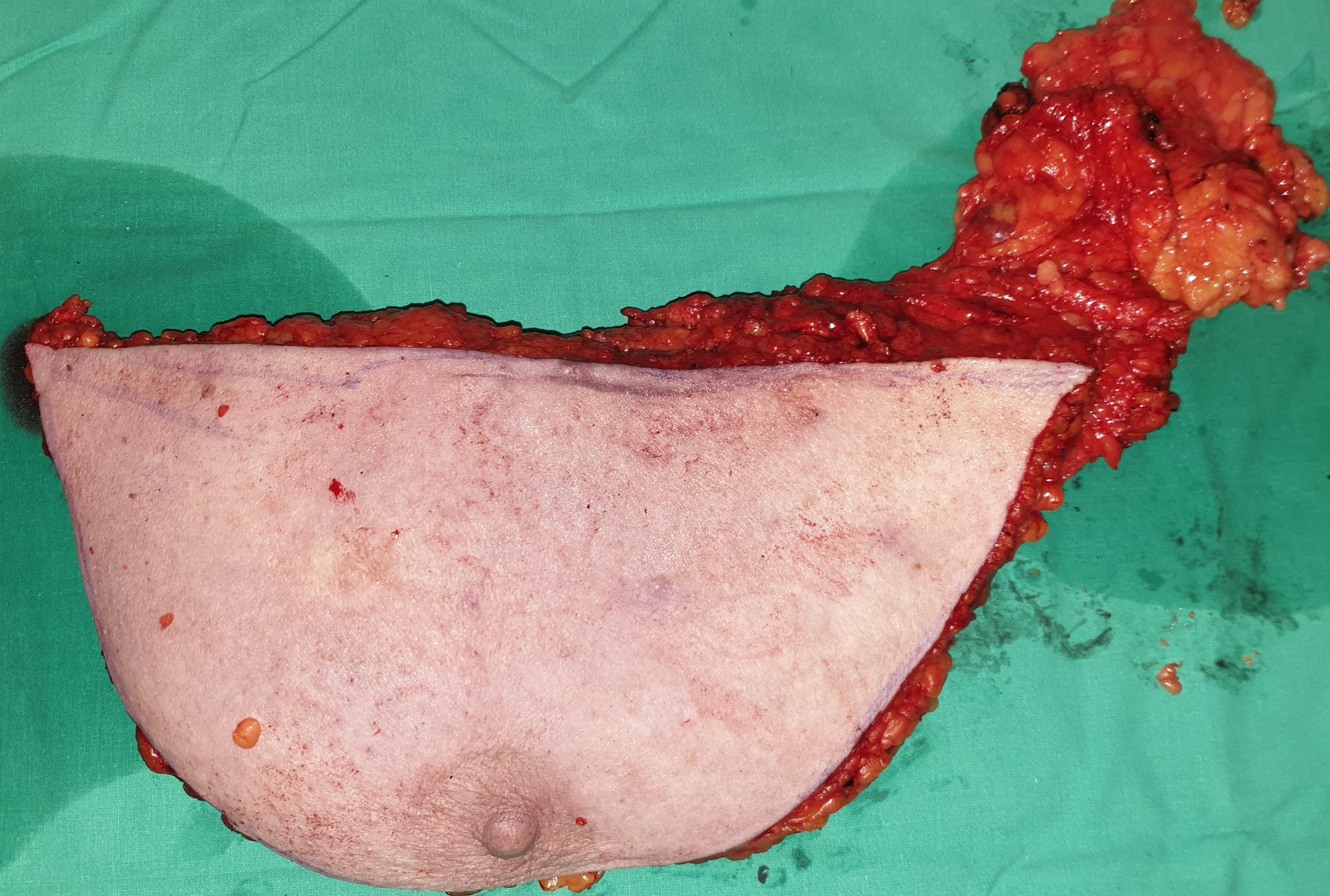 SIMPLE MASTECTOMY
