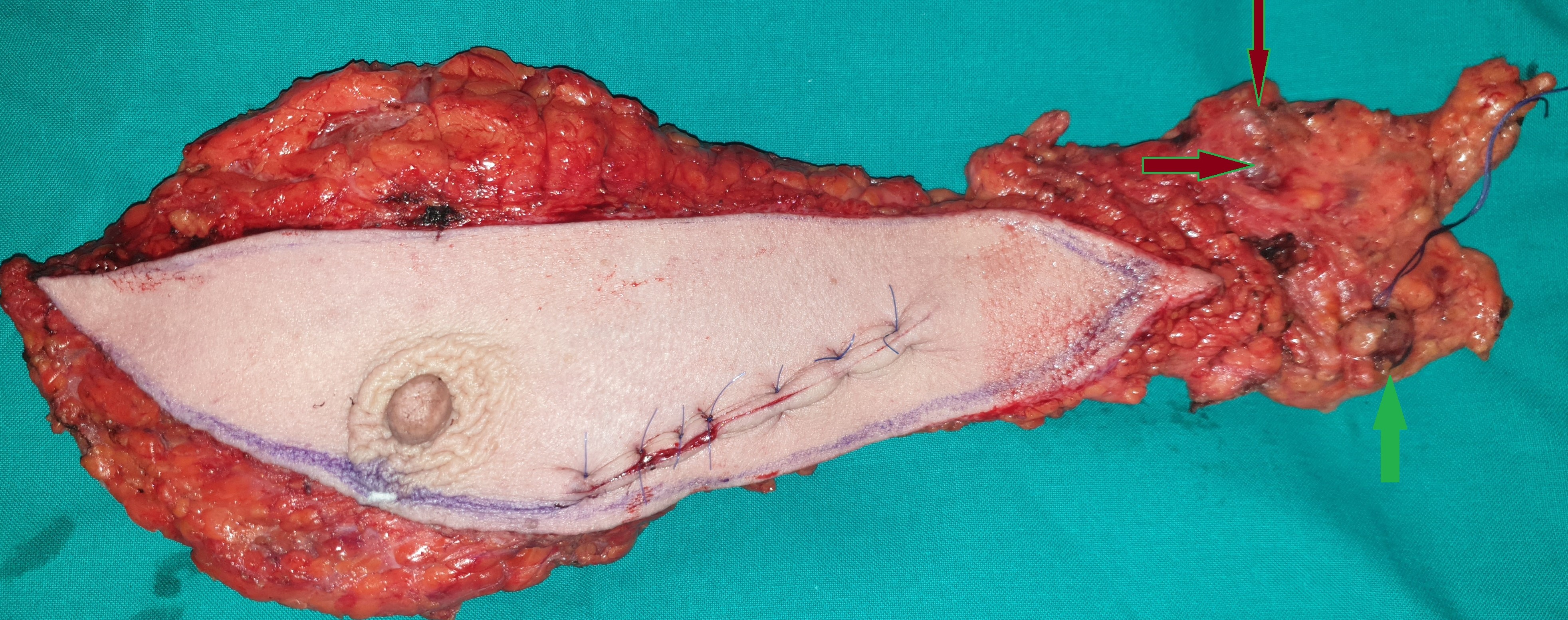 SIMPLE MASTECTOMY