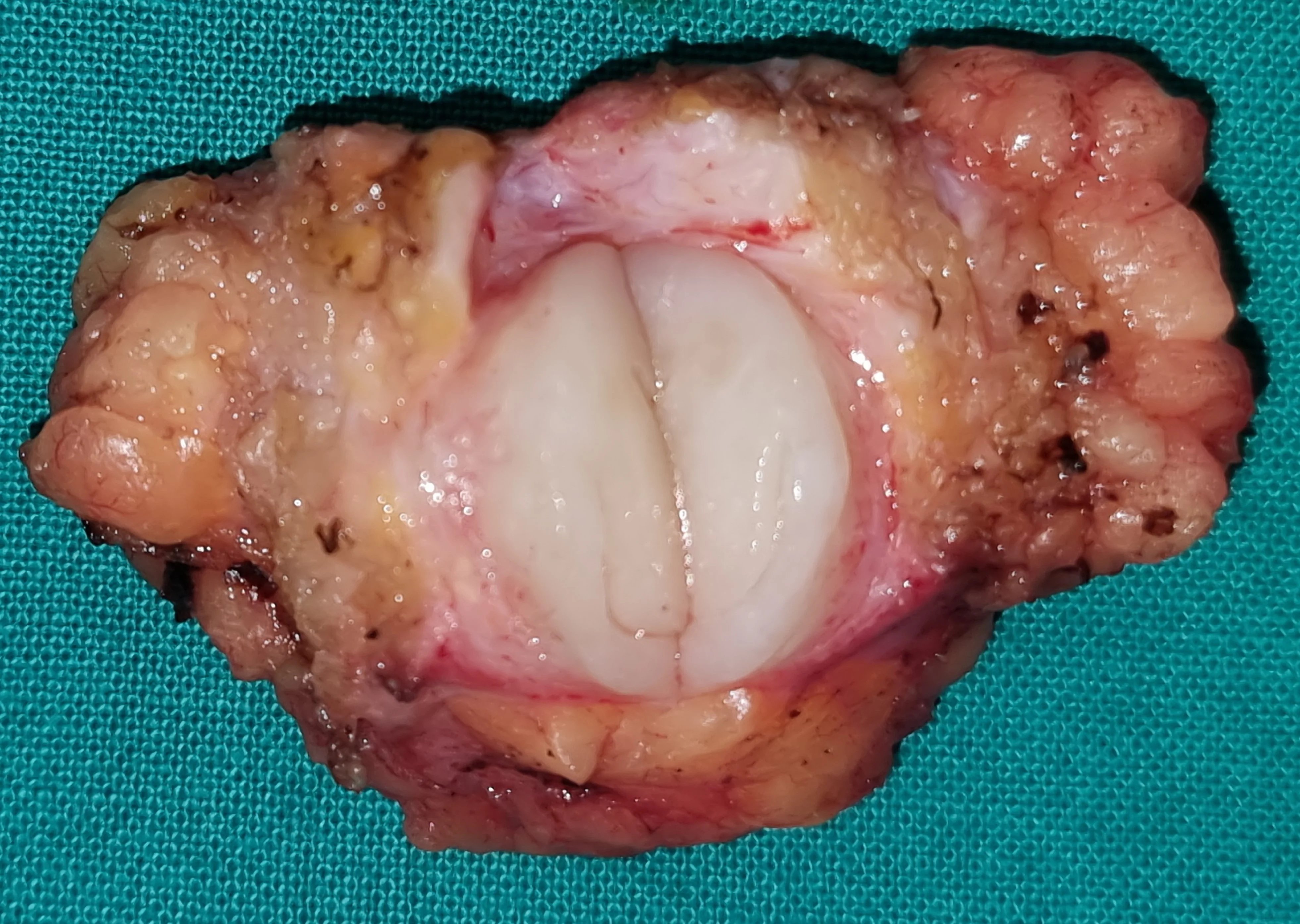 BREAST FIBROADENOMA