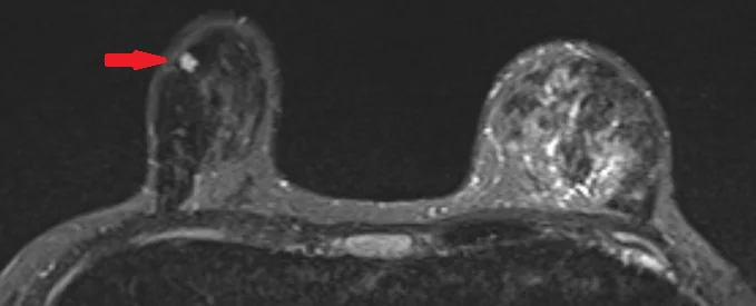 BREAST CARCINOMA