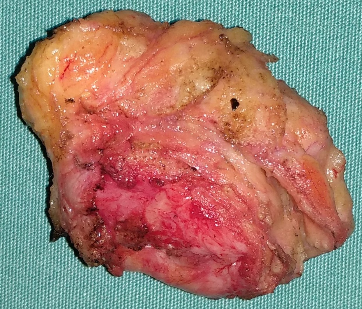 BREAST MICRODOCHECTOMY