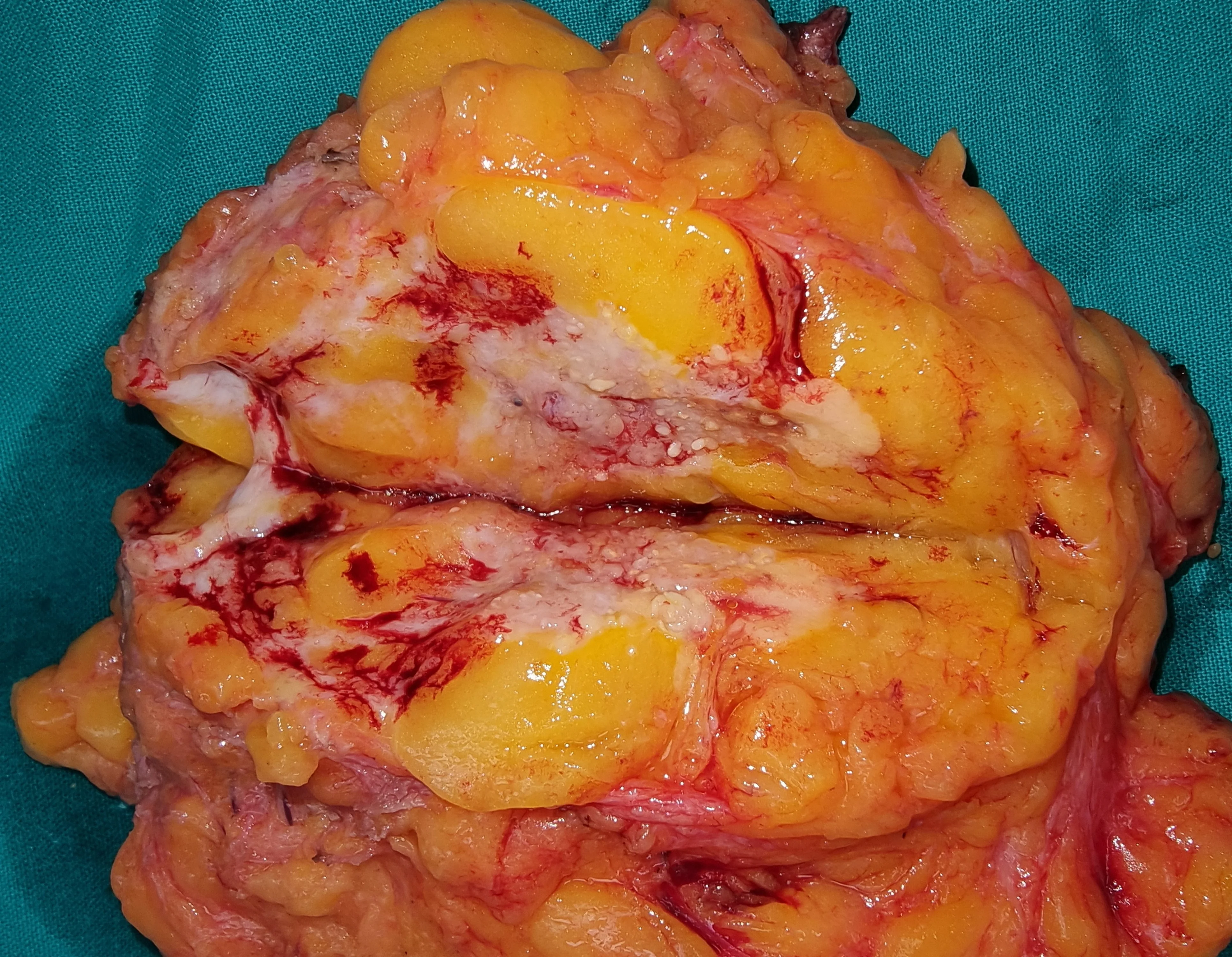 LOBULAR BREAST CARCINOMA