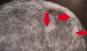 BREAST LIPONECROSIS