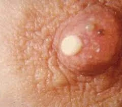 GALACTORRHEA