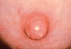 GALACTORRHEA