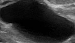 BREAST CYST