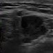 BREAST CYST