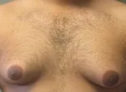 BILATERAL GYNECOMASTIA