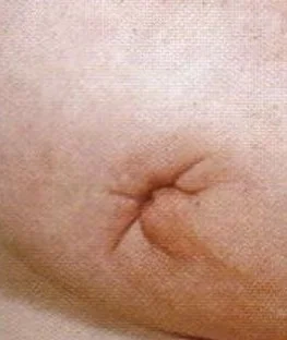 NIPPLE RETRACTION