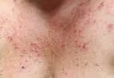 BREAST ECZEMA