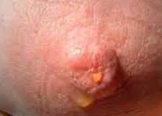 NIPPLE DISCHARGE