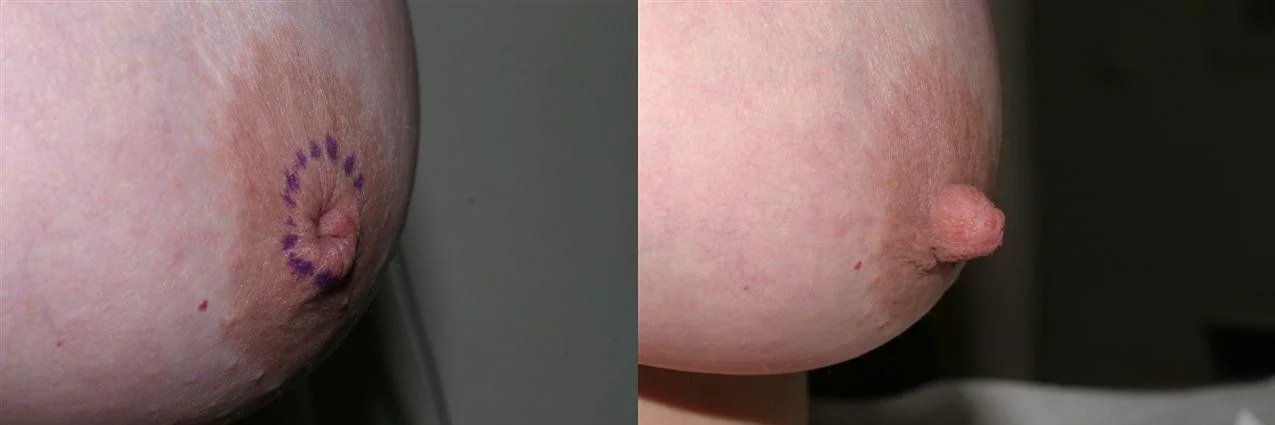 NIPPLE RETRACTION