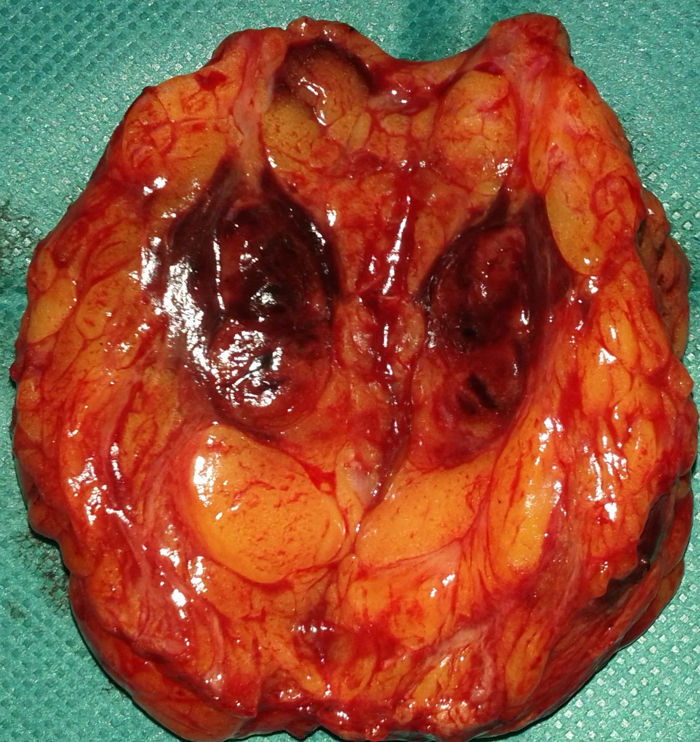 BREAST HEMATOMA
