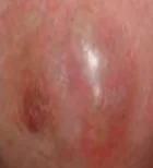 BREAST ABSCESS