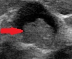 BREAST PAPILLOMA