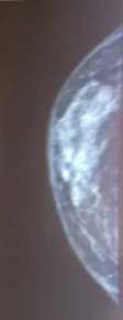 MALE MASTITIS