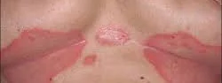 BREAST CADIDIASIS