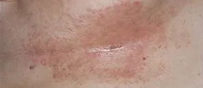 BREAST INTERTRIGO
