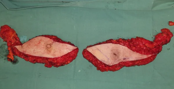 BILATERAL SIMPLE MASTECTOMY - AXILLARY LYPH NODE CLEARANCE