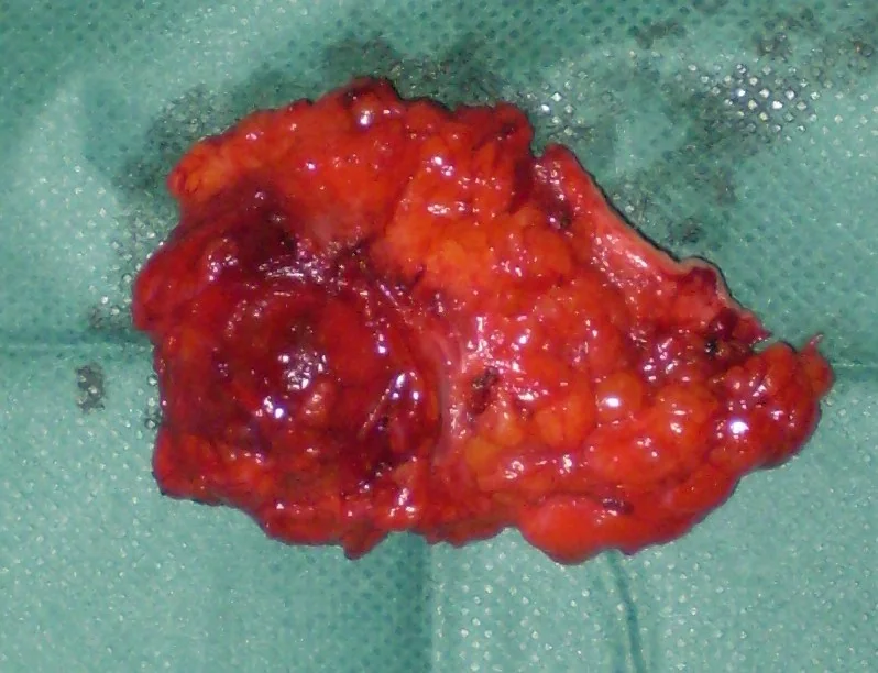 RECURRENCE BREAST CARCINOMA